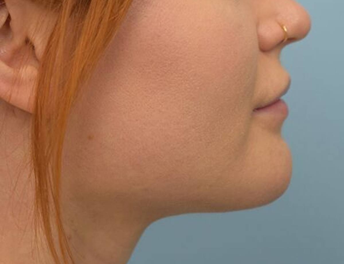 Chin Reduction Before & After Image