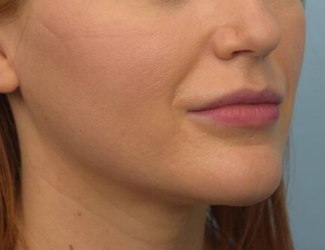 Chin Reduction Before & After Image