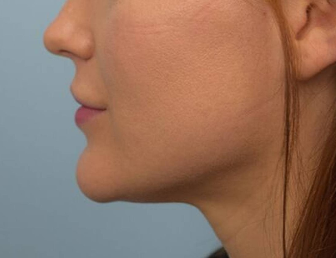 Chin Reduction Before & After Image