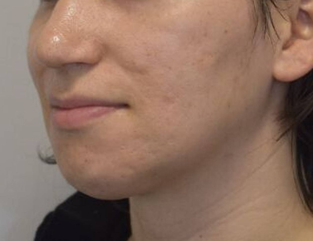 Chin Reduction Before & After Image