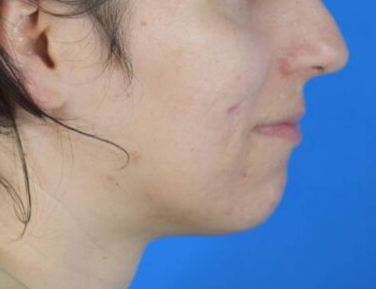 Chin Reduction Before & After Image