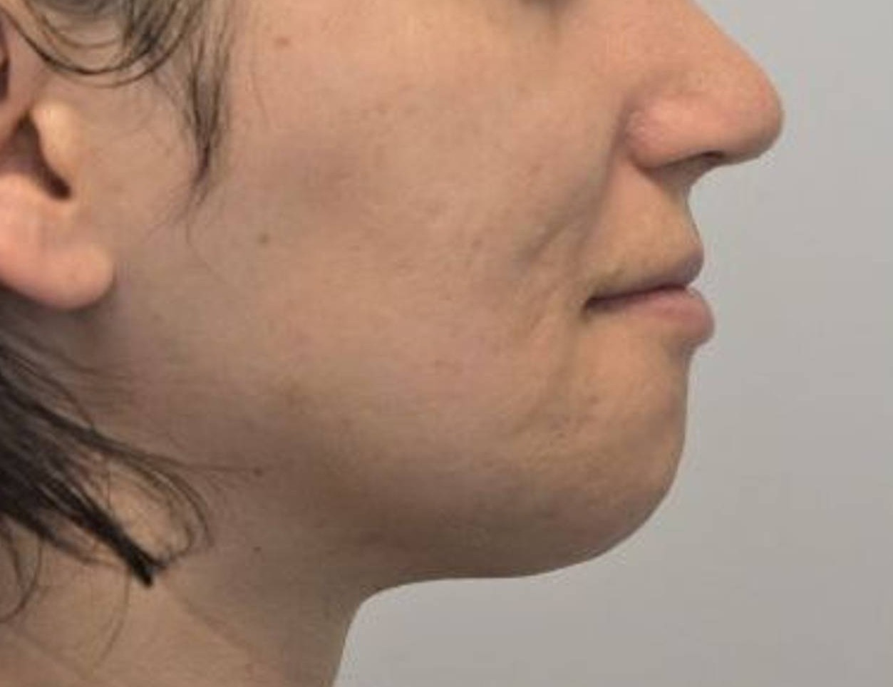 Chin Reduction Before & After Image