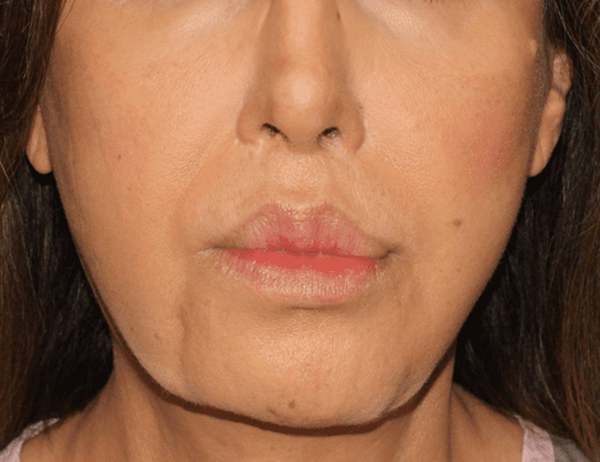 Chin Reduction Before & After Image