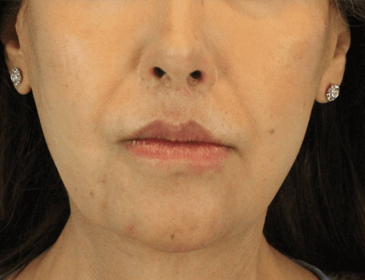 Chin Reduction Before & After Image