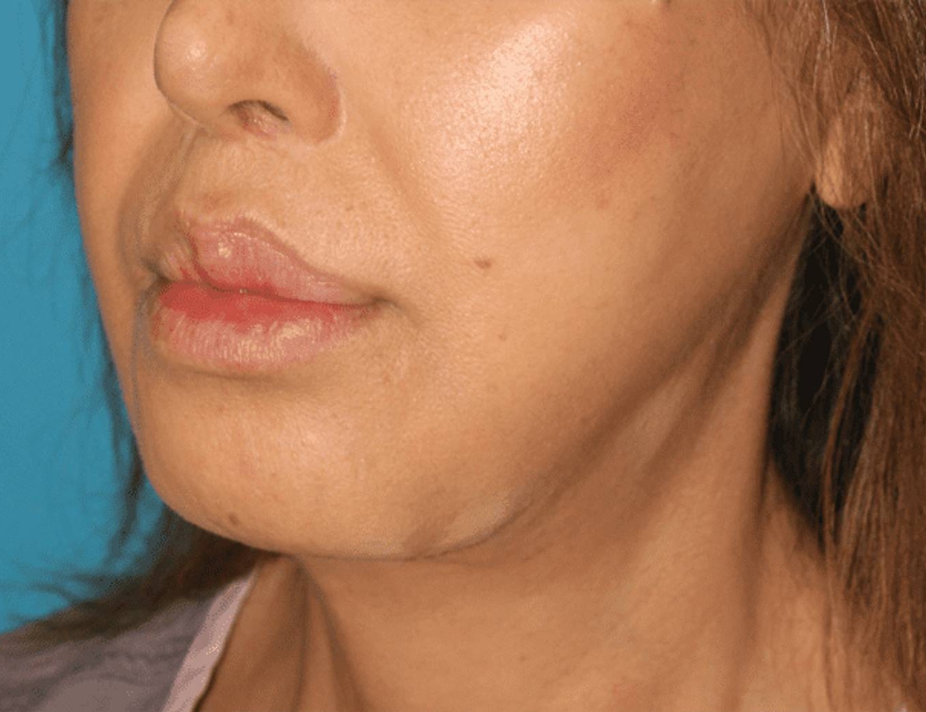 Chin Reduction Before & After Image