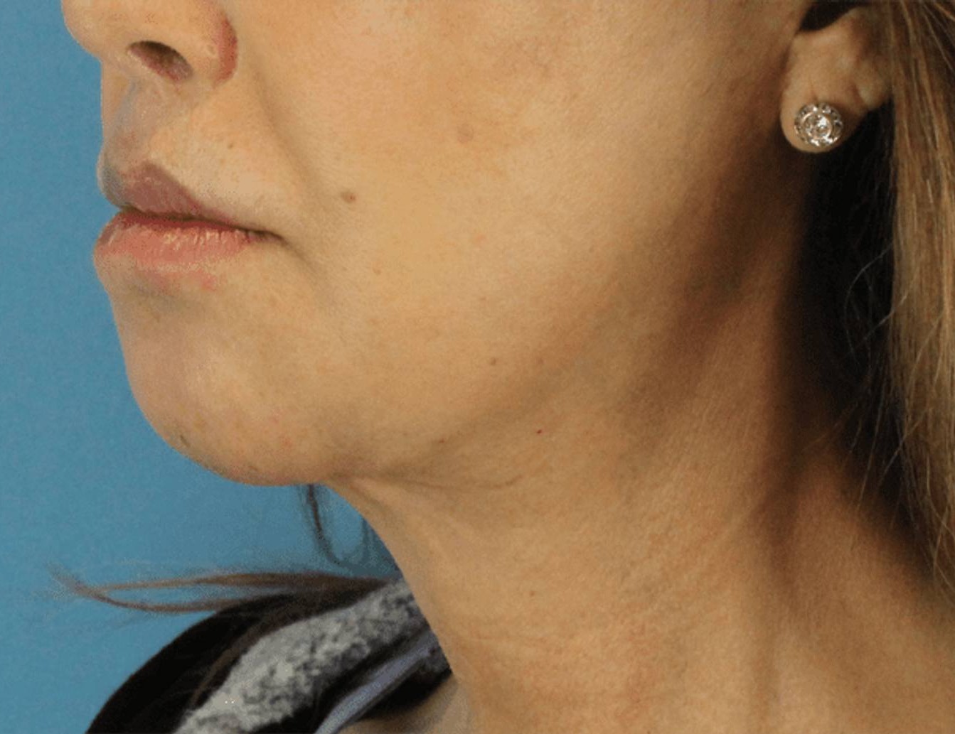 Chin Reduction Before & After Image