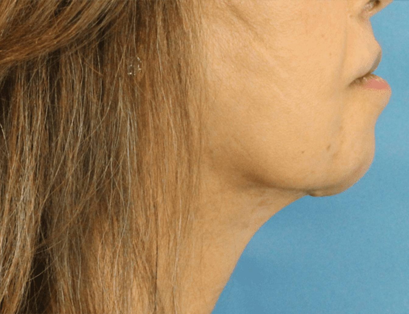 Chin Reduction Before & After Image