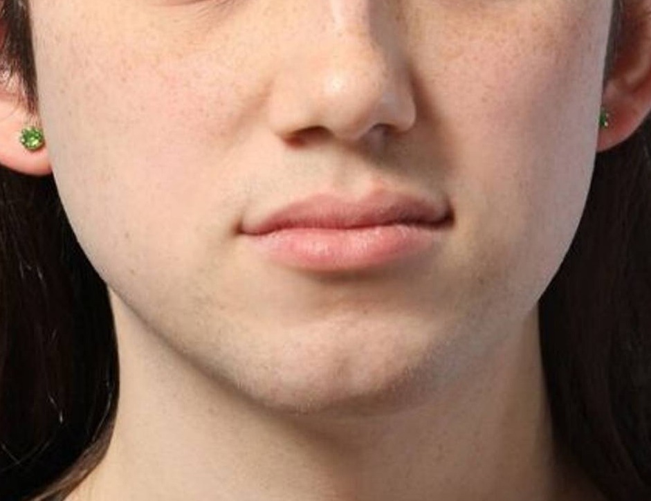 Chin Reduction Before & After Image