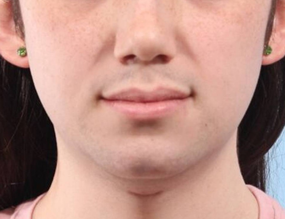 Chin Reduction Before & After Image