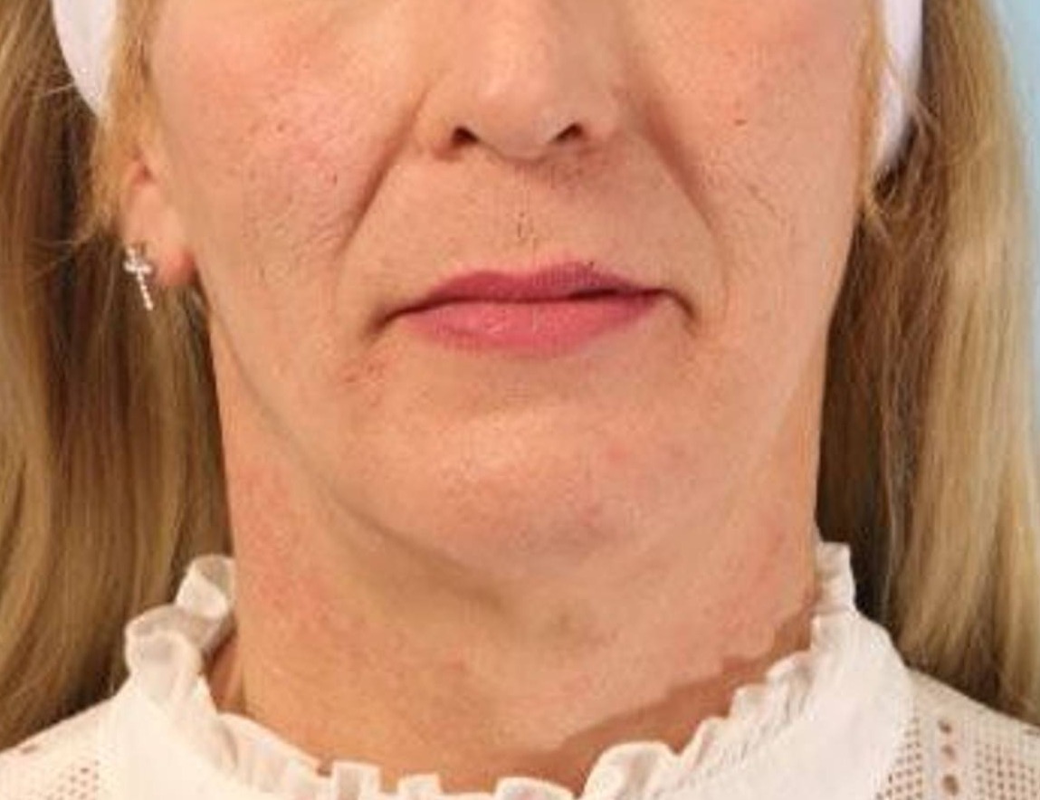 Chin Reduction Before & After Image