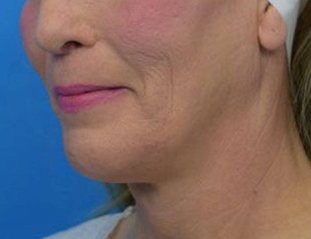 Chin Reduction Before & After Image