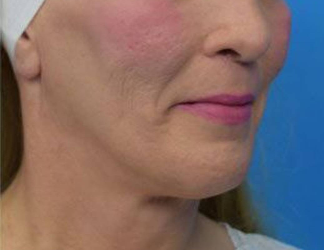 Chin Reduction Before & After Image