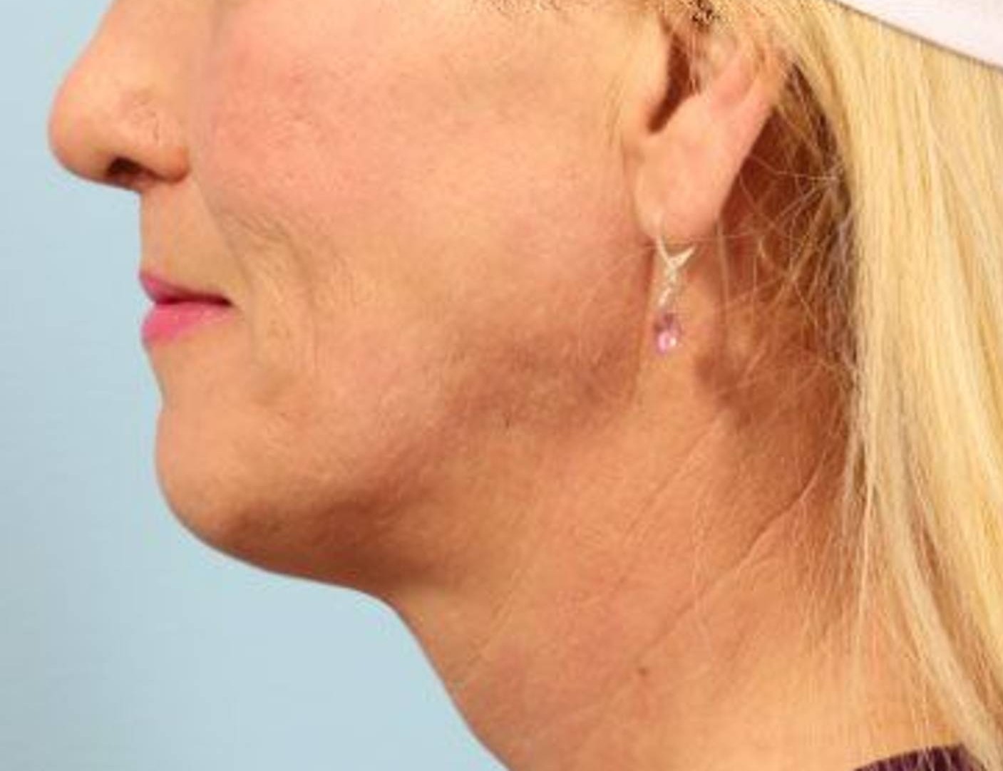 Chin Reduction Before & After Image