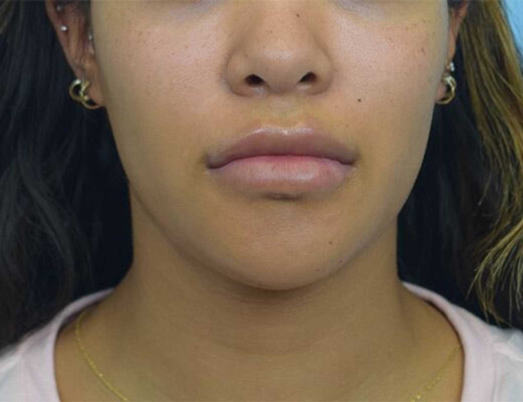 Chin Reduction Before & After Image