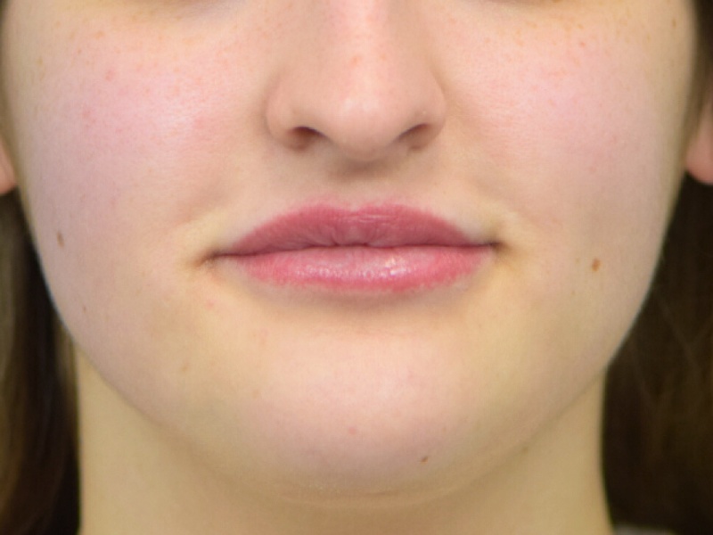 Chin Reduction Before & After Image