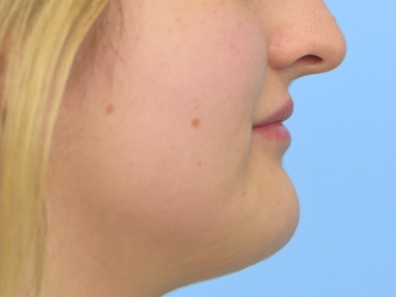 Chin Reduction Before & After Image