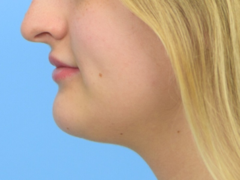 Chin Reduction Before & After Image