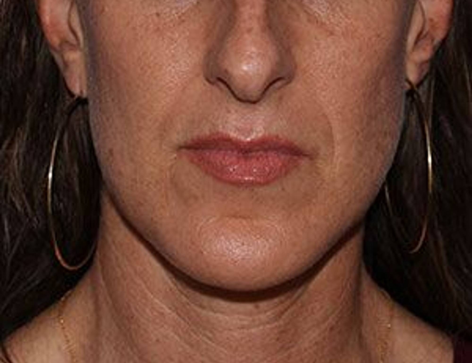 Chin Reduction Before & After Image