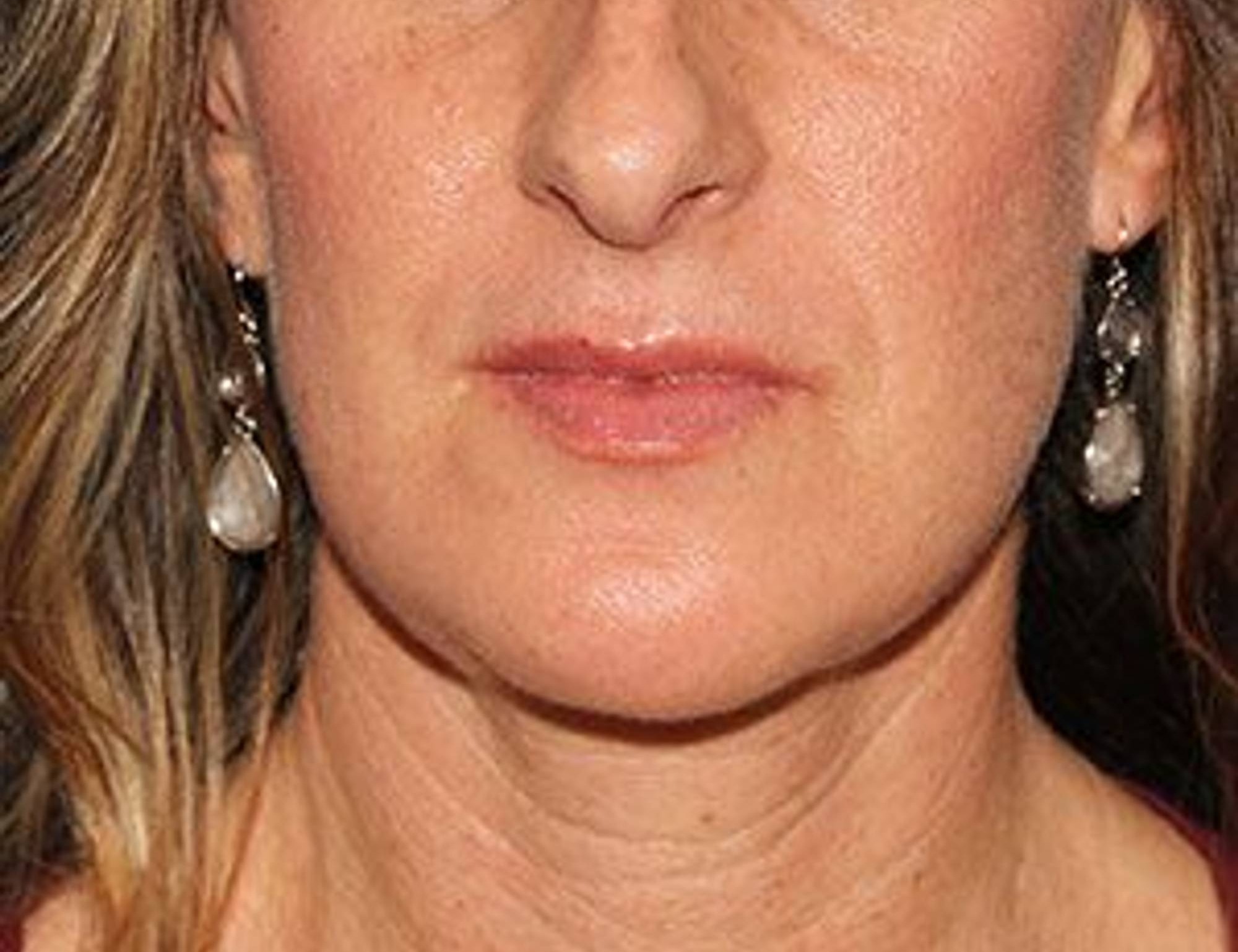 Chin Reduction Before & After Image