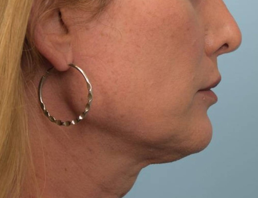 Chin Reduction Before & After Image