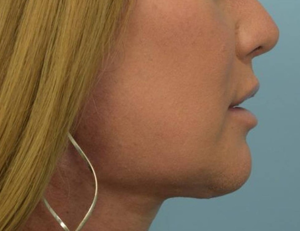 Chin Reduction Before & After Image