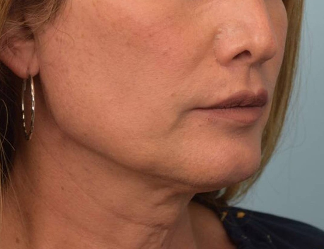 Chin Reduction Before & After Image