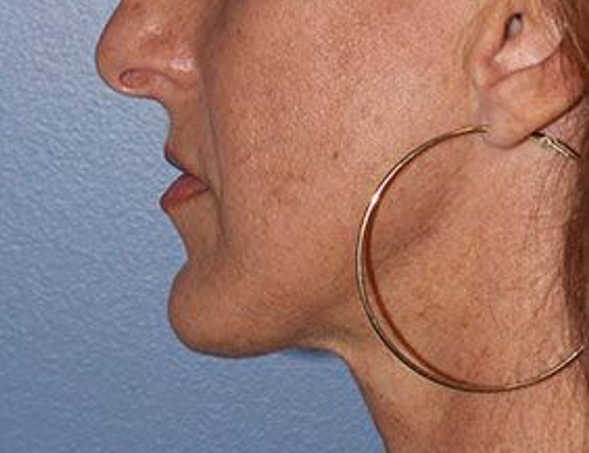 Chin Reduction Before & After Image