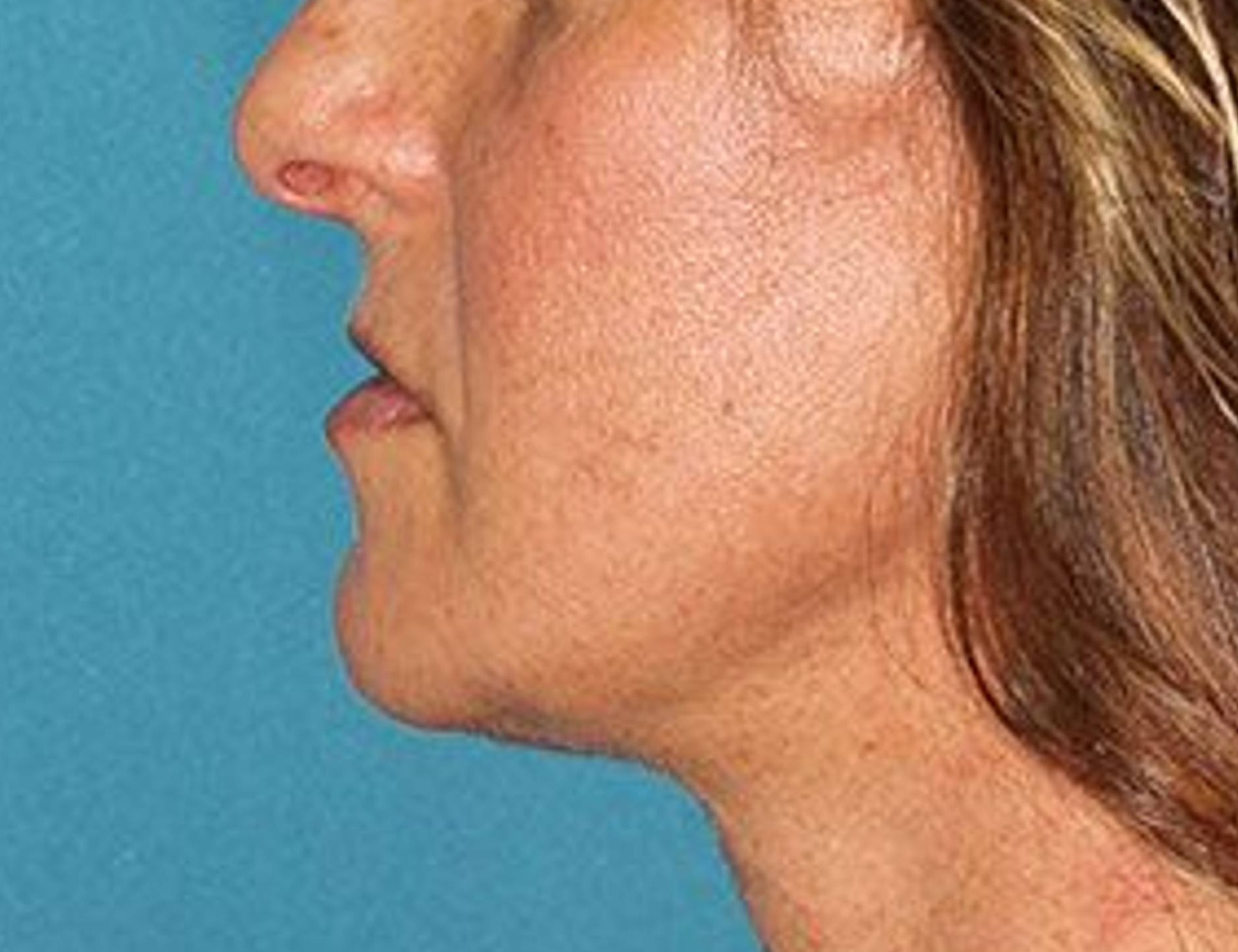 Chin Reduction Before & After Image