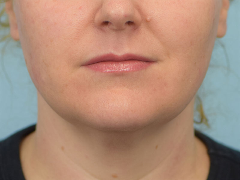 Chin Reduction Before & After Image