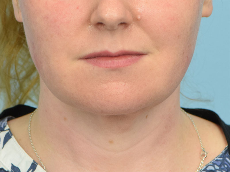 Chin Reduction Before & After Image