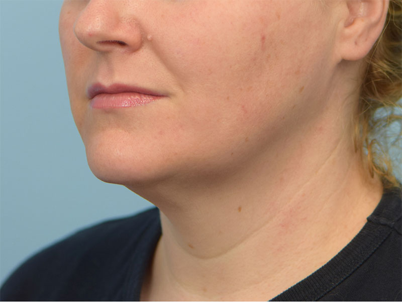 Chin Reduction Before & After Image