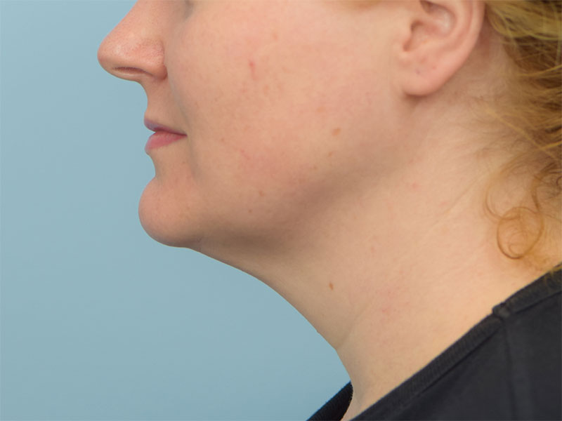 Chin Reduction Before & After Image