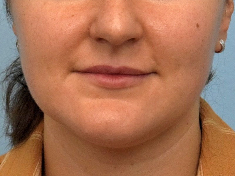 Chin Reduction Before & After Image
