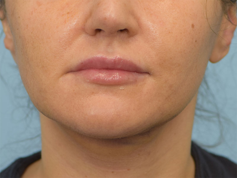 Chin Reduction Before & After Image