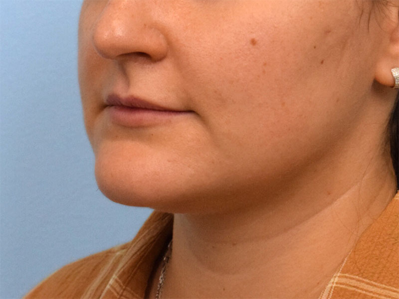 Chin Reduction Before & After Image