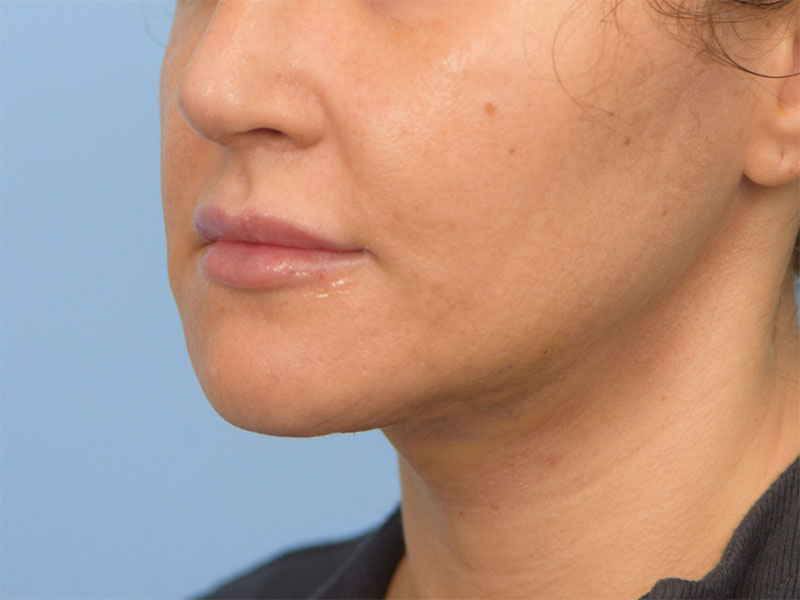 Chin Reduction Before & After Image