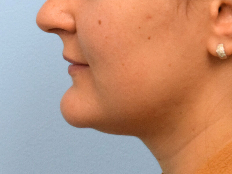 Chin Reduction Before & After Image