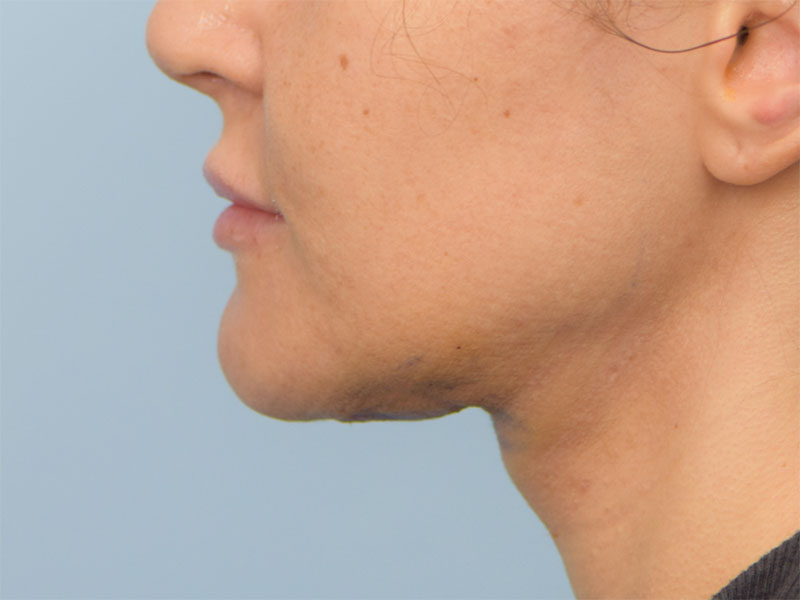 Chin Reduction Before & After Image