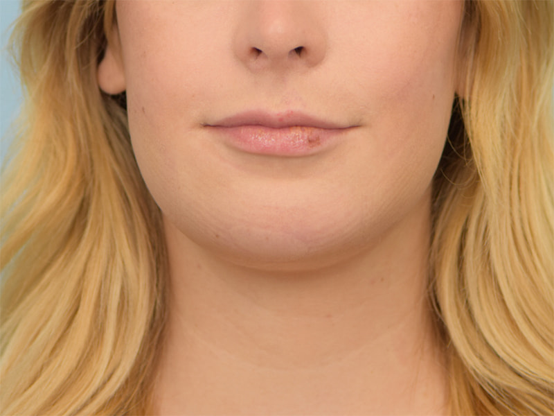 Chin Reduction Before & After Image