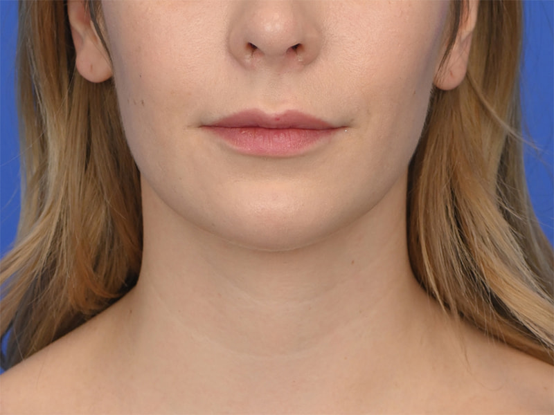 Chin Reduction Before & After Image