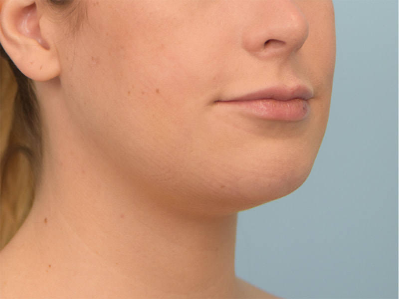 Chin Reduction Before & After Image