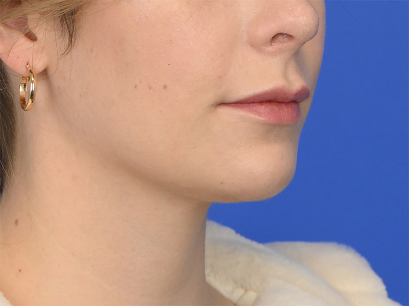 Chin Reduction Before & After Image