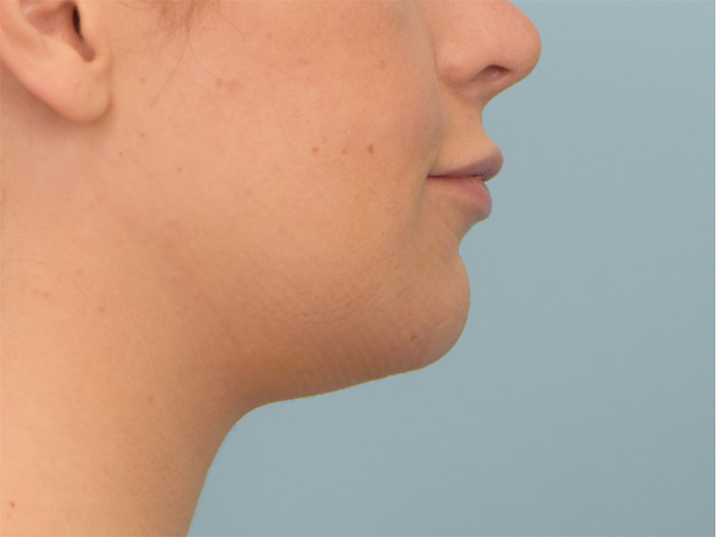 Chin Reduction Before & After Image