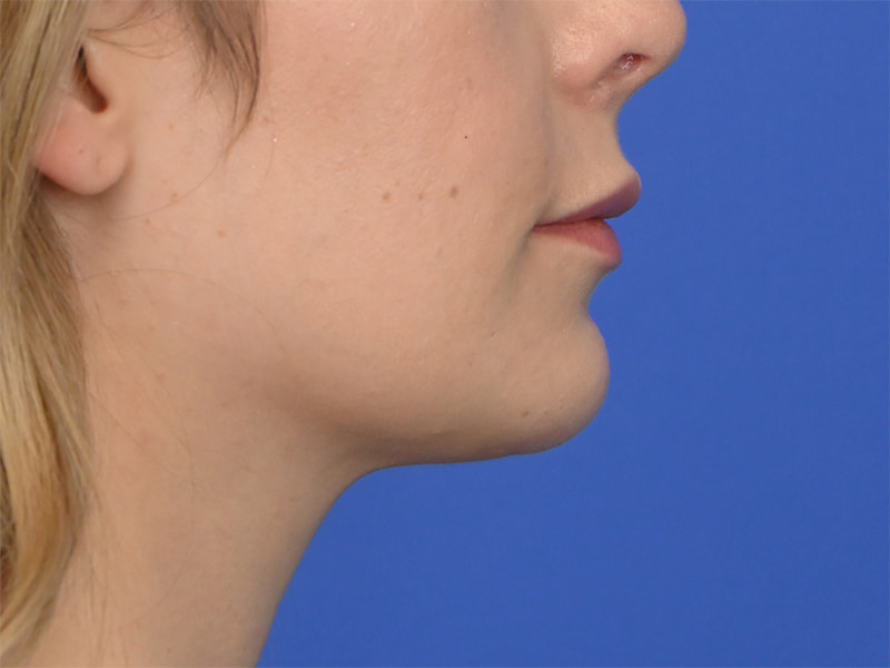 Chin Reduction Before & After Image