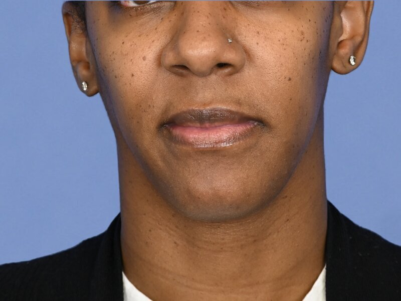 Chin Reduction Before & After Image
