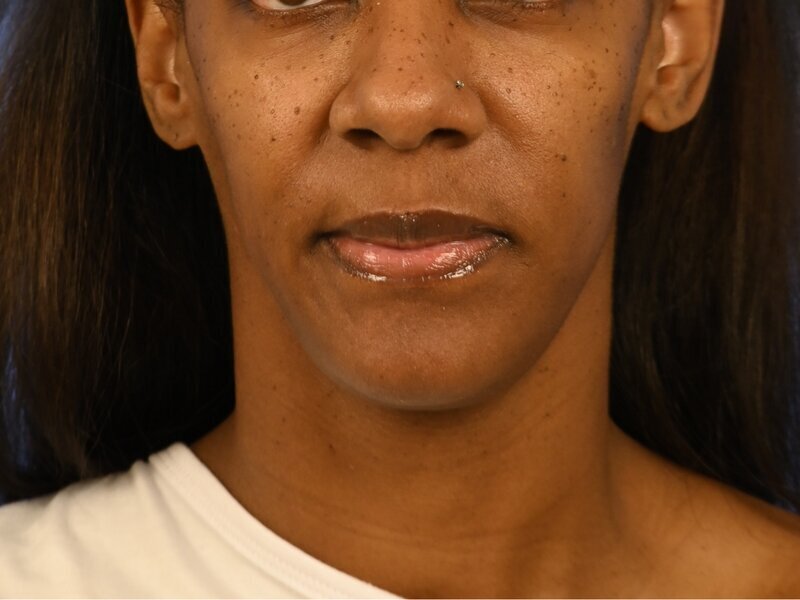 Chin Reduction Before & After Image