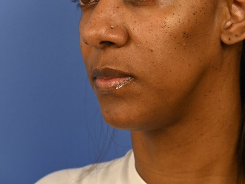 Chin Reduction Before & After Image