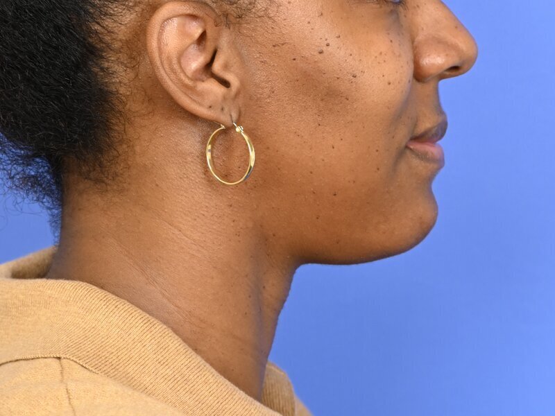 Chin Reduction Before & After Image