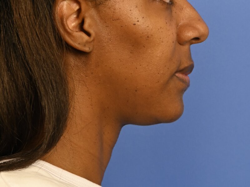 Chin Reduction Before & After Image
