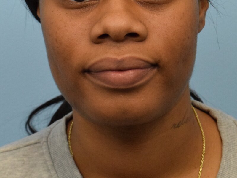 Chin Reduction Before & After Image
